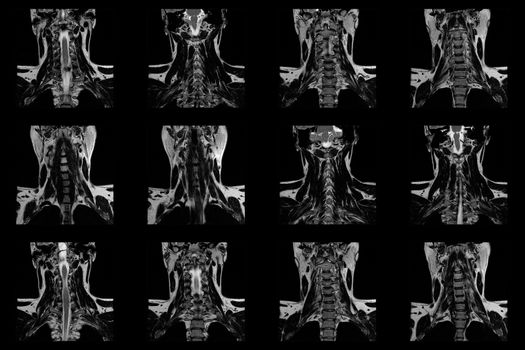 set of coronal MRI scans of neck area of caucasian male with herniaset of MRI scans of neck area of caucasian male with bilateral paramedial, with a left accent, extrusion of the C6-C7 segment with left-sided C7 radiculopathy, moderate paresis of the triceps of the left hand.
