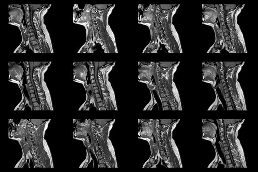 set of sagittal MRI scans of neck area of caucasian male with herniaset of MRI scans of neck area of caucasian male with bilateral paramedial, with a left accent, extrusion of the C6-C7 segment with left-sided C7 radiculopathy, moderate paresis of the triceps of the left hand.