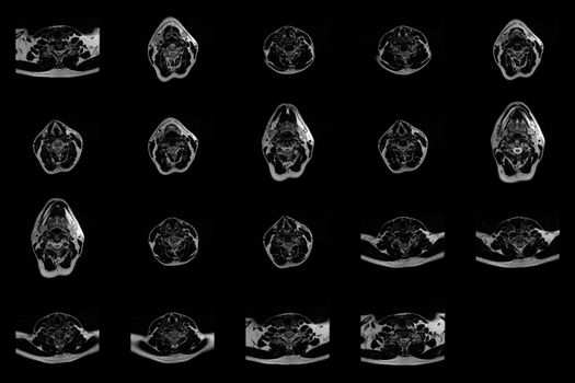 set of transverse MRI scans of neck area of caucasian male with herniaset of MRI scans of neck area of caucasian male with bilateral paramedial, with a left accent, extrusion of the C6-C7 segment with left-sided C7 radiculopathy, moderate paresis of the triceps of the left hand.
