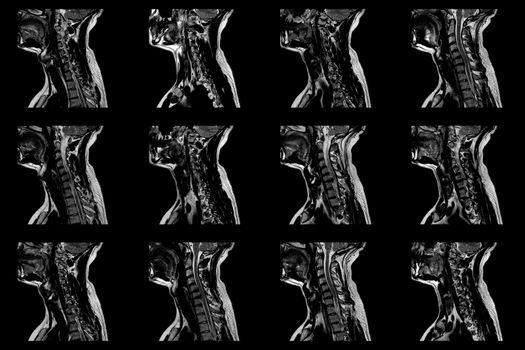 set of sagittal MRI scans of neck area of caucasian male with herniaset of MRI scans of neck area of caucasian male with bilateral paramedial, with a left accent, extrusion of the C6-C7 segment with left-sided C7 radiculopathy, moderate paresis of the triceps of the left hand.