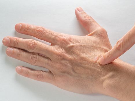 Close up of an old wart virus on a female caucasian hand.