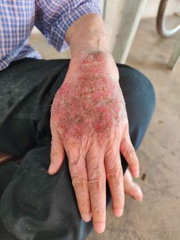 Close up dermatitis on skin of old asian man