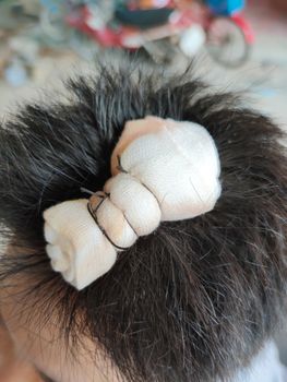 close-up asian man head injury with stitch and gauze