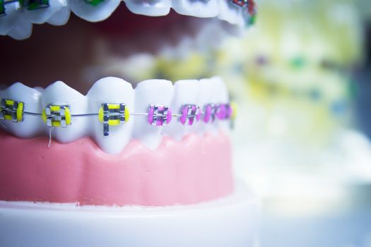 Model denture with metal orthodontics. No people