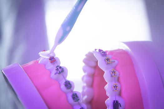 Model denture with metal orthodontics. No people