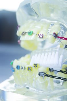 Model denture with metal orthodontics. No people