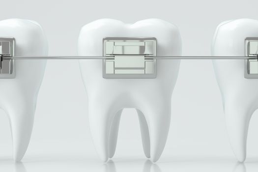 Dental braces and the teeth, 3d rendering. Computer digital drawing.