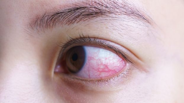 Red bloodshot eye of woman, irritated or infected, conjunctivitis eye or after cry.