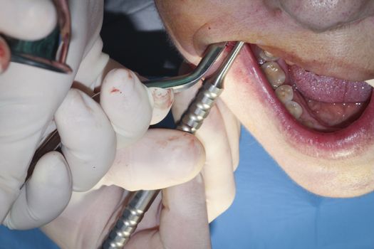 Real dental surgery in the molars