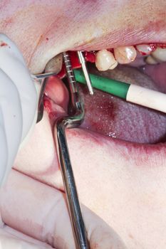 Real dental surgery in the molars