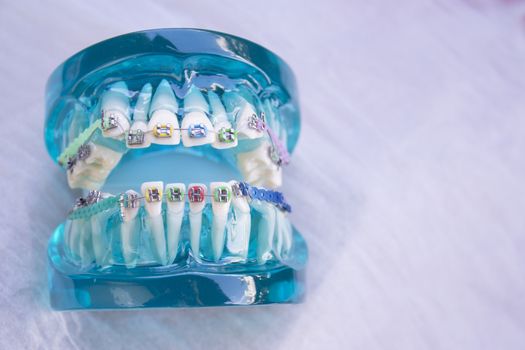 Denture for students with classic dental metal orthodontics. Color aesthetic couplings.