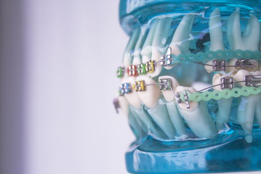 Denture for students with classic dental metal orthodontics. Color aesthetic couplings.