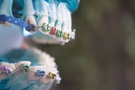 Denture for students with classic dental metal orthodontics. Color aesthetic couplings.