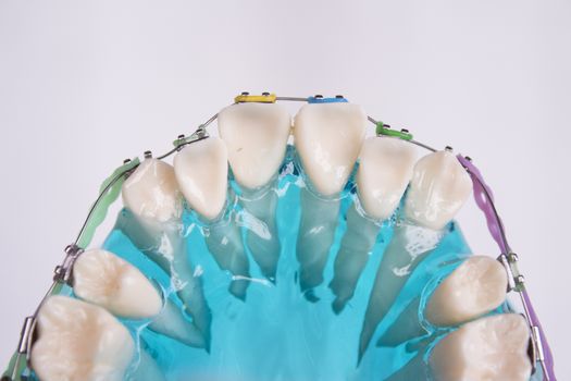 Denture for students with classic dental metal orthodontics. Color aesthetic couplings.