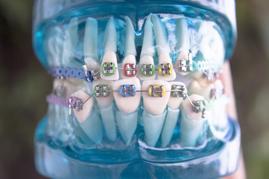 Denture for students with classic dental metal orthodontics. Color aesthetic couplings.