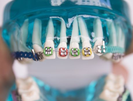 Denture for students with classic dental metal orthodontics. Color aesthetic couplings.