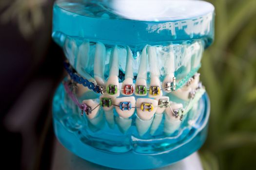 Denture for students with classic dental metal orthodontics. Color aesthetic couplings.