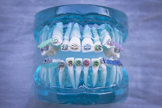 Denture for students with classic dental metal orthodontics. Color aesthetic couplings.