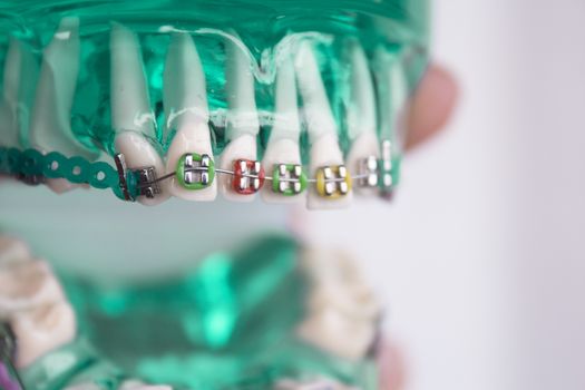 Denture for students with classic dental metal orthodontics. Color aesthetic couplings.