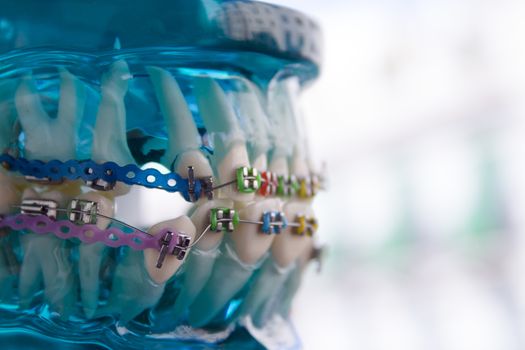 Denture for students with classic dental metal orthodontics. Color aesthetic couplings.