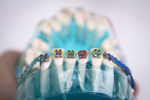 Denture for students with classic dental metal orthodontics. Color aesthetic couplings.