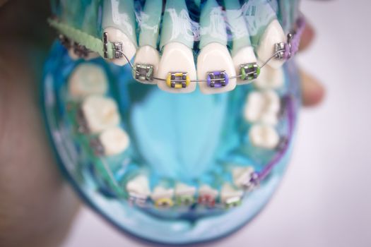 Denture for students with classic dental metal orthodontics. Color aesthetic couplings.