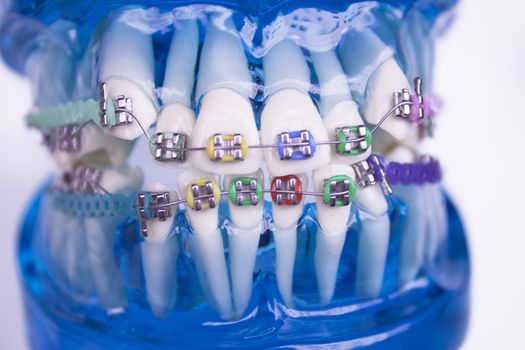 Denture for students with classic dental metal orthodontics. Color aesthetic couplings.