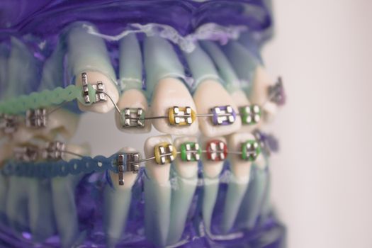 Denture for students with classic dental metal orthodontics. Color aesthetic couplings.