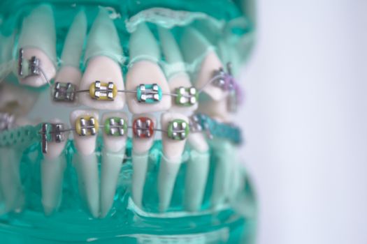 Denture for students with classic dental metal orthodontics. Color aesthetic couplings.