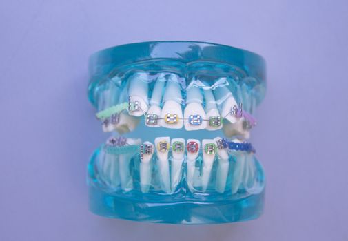 Denture for students with classic dental metal orthodontics. Color aesthetic couplings.