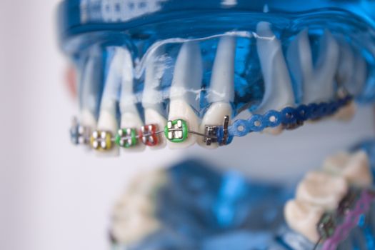 Denture for students with classic dental metal orthodontics. Color aesthetic couplings.