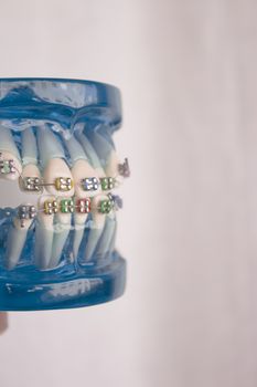 Denture for students with classic dental metal orthodontics. Color aesthetic couplings.