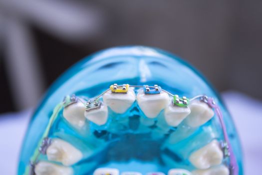 Denture for students with classic dental metal orthodontics. Color aesthetic couplings.