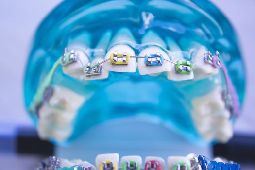 Denture for students with classic dental metal orthodontics. Color aesthetic couplings.