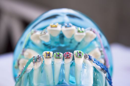 Denture for students with classic dental metal orthodontics. Color aesthetic couplings.