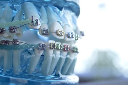 Denture for students with classic dental metal orthodontics. Color aesthetic couplings.