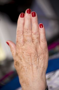 Hands of a middle aged woman with problems of rheumatism, osteoarthritis and skin blemishes