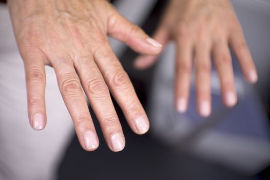 Hands of a middle aged woman with problems of rheumatism, osteoarthritis and skin blemishes