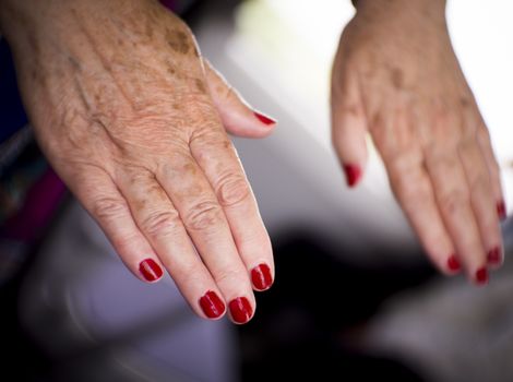 Hands of a middle aged woman with problems of rheumatism, osteoarthritis and skin blemishes