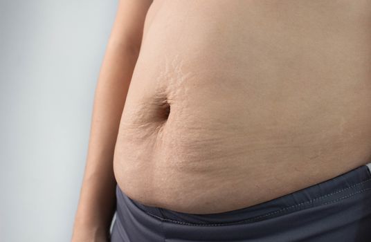 Close up of Woman showing belly skin with stretch marks and loose skin after giving birth. Health care for skin and body shape concept.