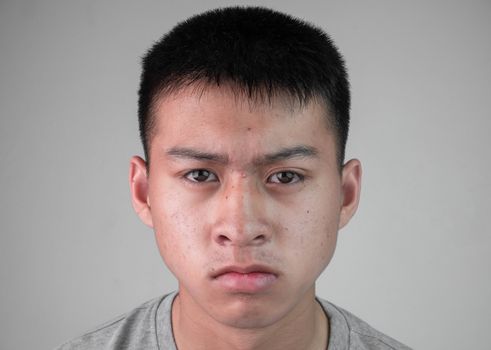 Portrait of a young handsome teenager boy in grey t-shirt with skin problem. Teen guy are stressed with acne on his face, isolated on grey background.
