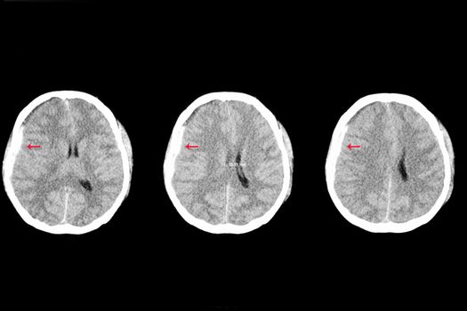 a brain CT scan of a patient with traumatic brain injury showing right subdural hemorrhage and brain edema with shifting of falx cerebri to the left