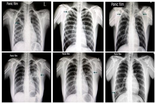 chest x-ray film of patients with various forms of pulmonary tuberculosis
