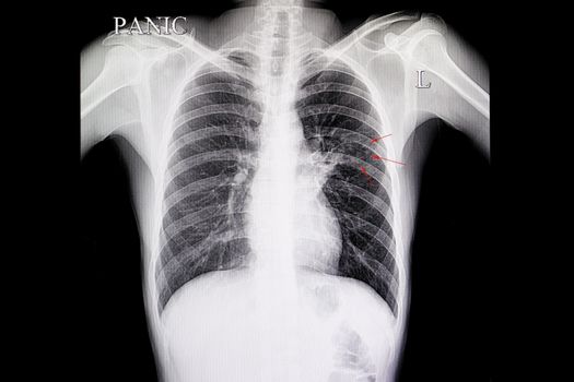 xray film of a patient with tuberculous reticulonodular infiltrations in the left middle lung (red arrows)