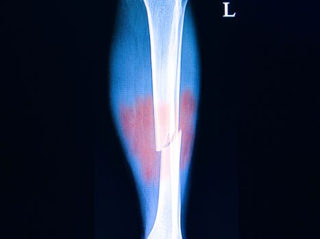 Xray film of a patient with a history of car accident showing fractures of both bones of his left legs