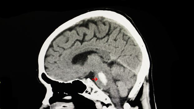 A CT scan of the brain of a patient with intracranial hemorrhage. The lesion is in the pons in this image