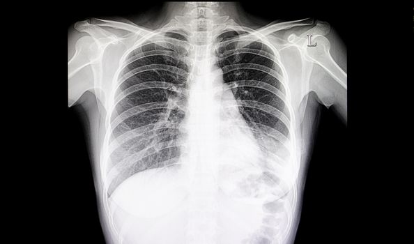 Chest xray film of a patient having pneumonia in his left lung.