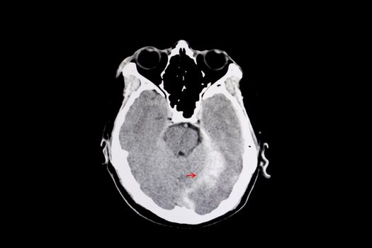 CT scan of a brain of a patient with intracerebral hemorrhage from traumatic brain injury (TBI).