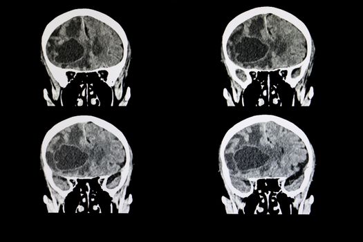 CT scan of a brain of a patient with a large metastatic tumor