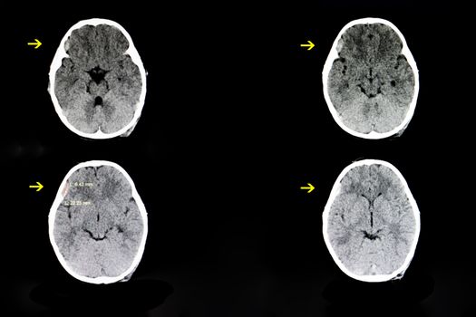 CT scan of a brain of a 4 year old child with a history of crush injury (hit by a falling TV) showing a small subdural hematoma in his right frontotemporal cerebral area.